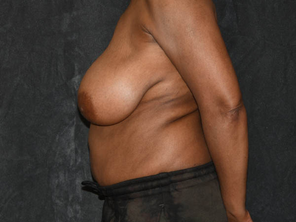 Breast Reduction